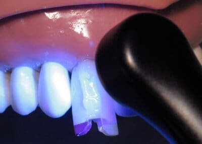 Light Curing of the overmolded tooth