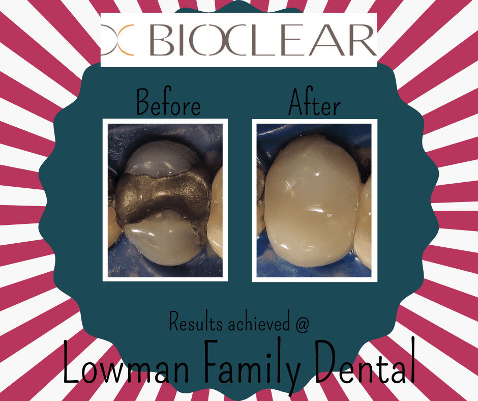 Finished Posterior Case Example - dark filling replaced with Bioclear